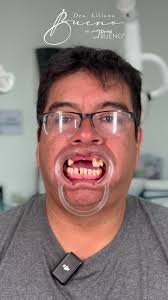 Transforma tu bienestar con implantes dentales en Polanco