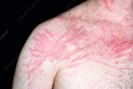 Image result for Dermatographism