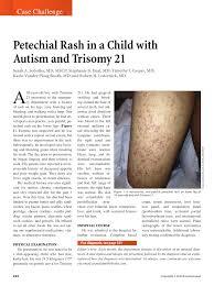 Petechiae are tiny purple, red, or brown spots on the skin. Pdf Petechial Rash In A Child With Autism And Trisomy 21