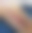 Image result for Skin Tear