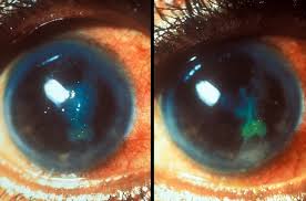 Maladies Et Troubles Oculaires Institut Catala De Retina