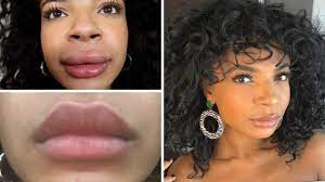 There is no given timeline for a swollen lip to go back to normal. How Long Does Swelling Last After Juvederm Public Health