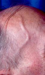 Educational image placeholder: artery wall inflammation in giant cell arteritis