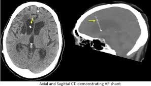 Axial And Sagittal Ct Demonstrating Ventriculoperitoneal Vp Shunt Download Scientific Diagram