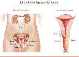 Dolayısıyla rahim kanserinin komşu dokulara sıçrama olasılığı da bulunuyor. Rahim Agzi Kanseri Belirtileri Ve Tedavisi