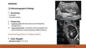 What Is Kidney Parenchymal Disease And What Are Its Symptoms? - Rbh