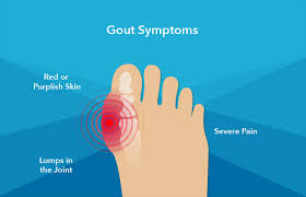Image result for gout symptoms knee