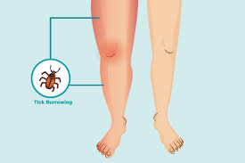 Lyme Arthritis Symptoms And Treatment