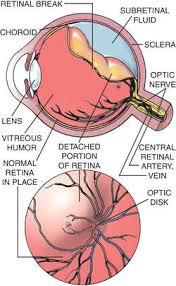It's not clear exactly why pvd can lead to retinal detachment in some people and there's nothing you can do to prevent it. Retinal Tear Definition Of Retinal Tear By Medical Dictionary