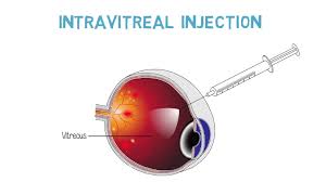 We are affiliated with newcastle eye hospital, the only hospital exclusive to eye surgery in the hunter valley licensed with the department of health. Intravitreal Eye Injections Erie Retinal Surgery