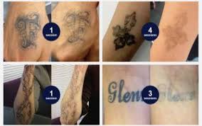 As a result, they often offer a better price range than the other facilities that have more than one area of expertise. Tattoo Removal Treatment Cost Elegant Arts Tattoo