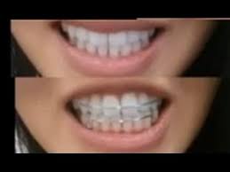 There's no single best type for everyone. Which Retainers Are Better Clear Vs Metal Youtube