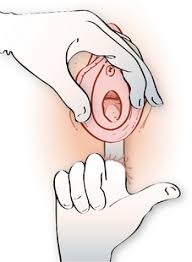 Pour voir si ton hymen est intact tu peux regarder ta vulve couchée sur le dos avec un petit miroir. 2 Investigations En Gynecologie Medicine Key