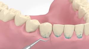Zahnstein lässt sich mit hausmitteln nicht entfernen. Professionelle Zahnreinigung Ecdi