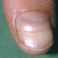Have a blue/green looking horizontal line (going left to right) not super big nor has it grown/changed. Nail Clinic Beau S Lines Nailpro