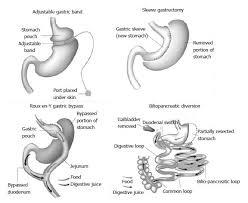 Bariatric Surgery And Long Term Nutritional Issues