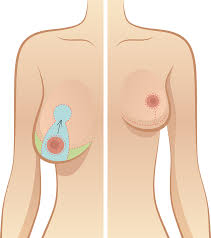 Pseudogynecomastia (fatty breast tissue) is typically not covered by insurance. Breast Reduction Surgery In Houston Tx Aesthetic Surgery Institute