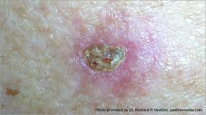 Although it is the most commonly diagnosed cancer in american women, breast cancer can impact people of all genders. Skin Cancer Pictures Photos Pictures Of Skin Cancer