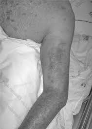 Image result for Tropical Edema