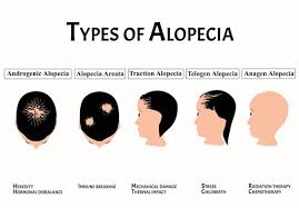 Food and drug administration approved hcq for symptoms of lupus and rheumatoid arthritis, particularly skin inflammation, hair loss, mouth sores, fatigue, and joint pain. My Hair Is Falling Out Female Health Collective
