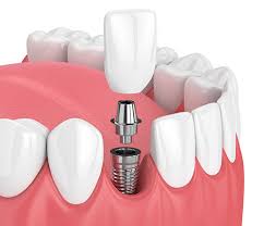 How Much Do Dental Implants Cost in Houston? Guide 2025