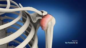 Image result for Frozen Shoulder