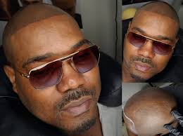 Bring back your confidence with SCALP MICROPIGMENTATION 💉 Instant, natural  & long-lasting results... A quick, effective solution ! NO surgery & NO  complicated maintenance... Choose your look: Natural hairline Modern