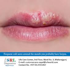 In mature virus particles, outside the capsid is an amorphous proteinaceous layer, the tegument, surrounded by a lipid envelope derived from host cell membranes. Srl Diagnostics Nepal Pvt Ltd More Than 3 7 Billion People Under The Age Of 50 Suffer From The Herpes Simplex Virus Type 1 Hsv 1 People Under The Age Of 50 Have