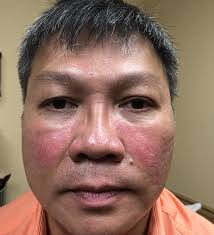 Systemic Lupus Erythematosus: Diagnosis and Treatment