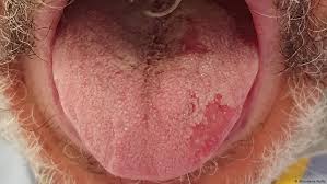 Lengua Covid Y Otros Sintomas Del Coronavirus En La Piel Coronavirus Dw 29 01 2021