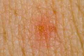 Image result for scabies symptoms