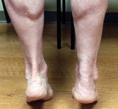 It can cause joint pain, stiffness. Return Of Strength After Achilles Tendon Surgery Lower Extremity Review Magazine