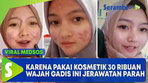 Viral Karena Pakai Kosmetik Rp 30 Ribuan Di Supermarket Wajah Gadis Jerawatan Parah Youtube