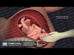 Image result for Shoulder Presentation