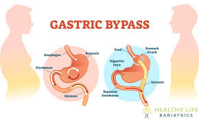 United healthcare insurance requirements for bariatric surgery gastric bypass gastric sleeve gastric banding lap band. Gastric Bypass Surgery Weight Loss Los Angeles Healthy Life Bariatrics