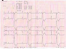 Reentrant supraventricular tachycardias (svt) involve reentrant pathways with a component above the bifurcation of the his bundle. Elektrokardiographie Rhythmusstorungen Wikibooks Sammlung Freier Lehr Sach Und Fachbucher