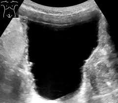 Acute Urinary Retention Clinical Features Management Teachmesurgery