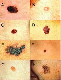 What is the most common cancer? Test Yourself Could You Spot A Skin Cancer Never Miss A Melanoma Doctor Stu S Science Blog