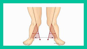 Health Tips Can Squats And Calf Raises Improve Bow Legs Bow Legged Correction Knock Knees Bow Legged