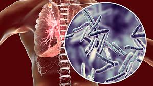 В умовах гепатита COVID-19 не может быть забувати туберкульоз |  Громадський Простір
