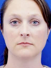 Nasal Aesthetic Nuances