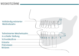 Weisheitszähne werden oft unter lokaler betäubung entfernt. Weisheitszahn Op In Zurich Bellevue Zahnarzte