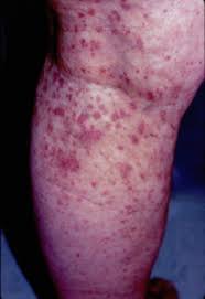 You will find them all over your skin in various parts of your body but mostly in your arms and lower legs. Purpuric Rash An Overview Sciencedirect Topics