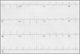 What every physician needs to know. File 80 Rvh And Lae In Mitral Stenosis Jpg Wikidoc