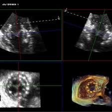 Echocardiographic Imaging For Transcatheter Tricuspid Valve Interventions