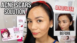 Seoul White Korea Say Goodbye To Acne Scars With Seoul White Korea Facebook