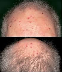 Occasionally adults may contract hfm, although it is usually milder. Two Cases Of Hand Foot And Mouth Disease Involving The Scalp Html Acta Dermato Venereologica