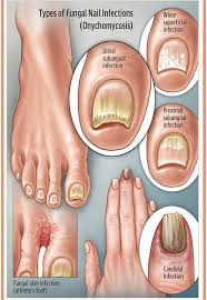 How To Prepare An Apple Cider Vinegar For Toenail Fungus Foot Soak Nail Fungus Cure Fungal Nail Infection Fungal Nail