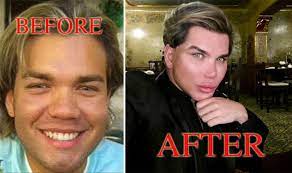 Rodrigo alves compared his body to a car, saying it requires a constant maintenance. (this morning/youtube). Rodrigo Alves Before And After Pics Human Ken Doll Who Has Had Fifty Procedures Express Co Uk
