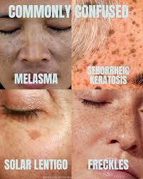 Image result for Solar Lentigo